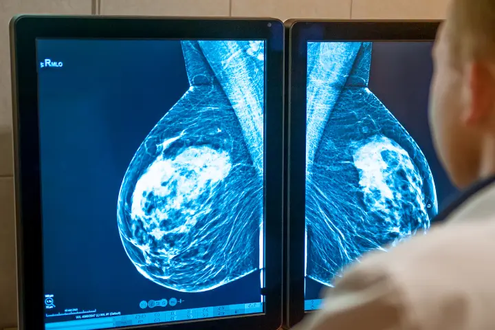 XRay, Breast Lump XRay, Breast Diagnosis, XRay Comparison, Beacon Hosptial