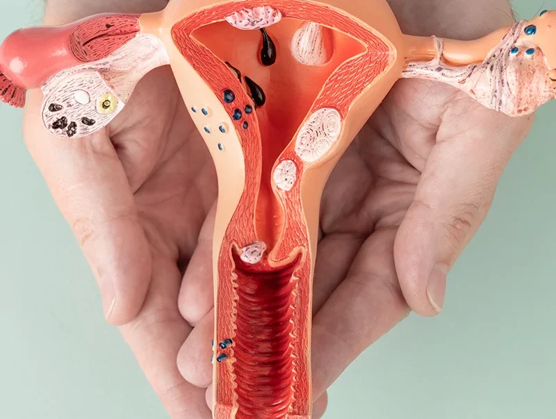 Vulva-Cancer-Beacon-Hospital