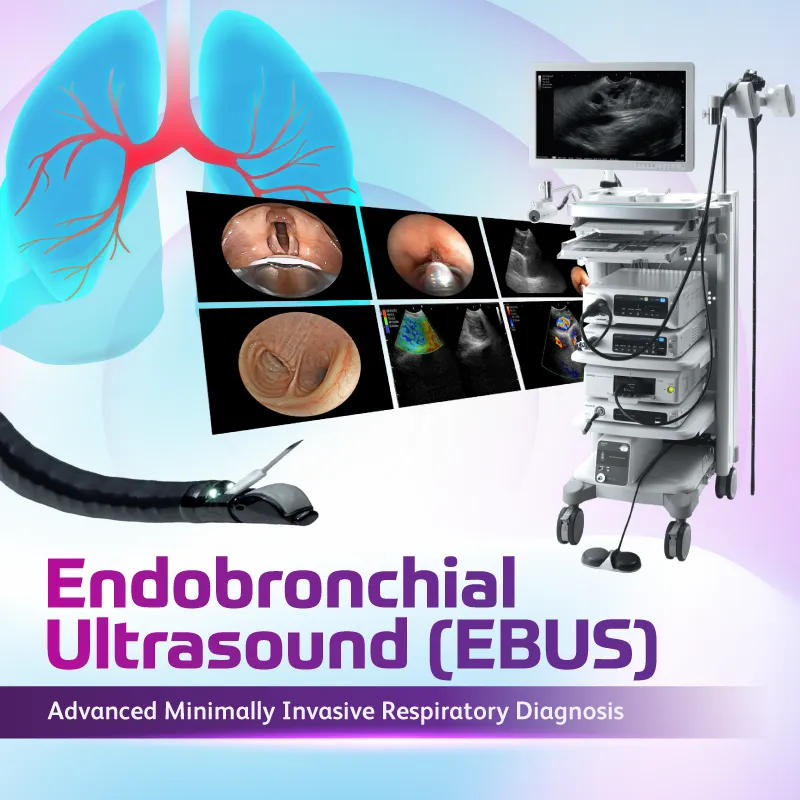Endobronchial Ultrasound (EBUS)