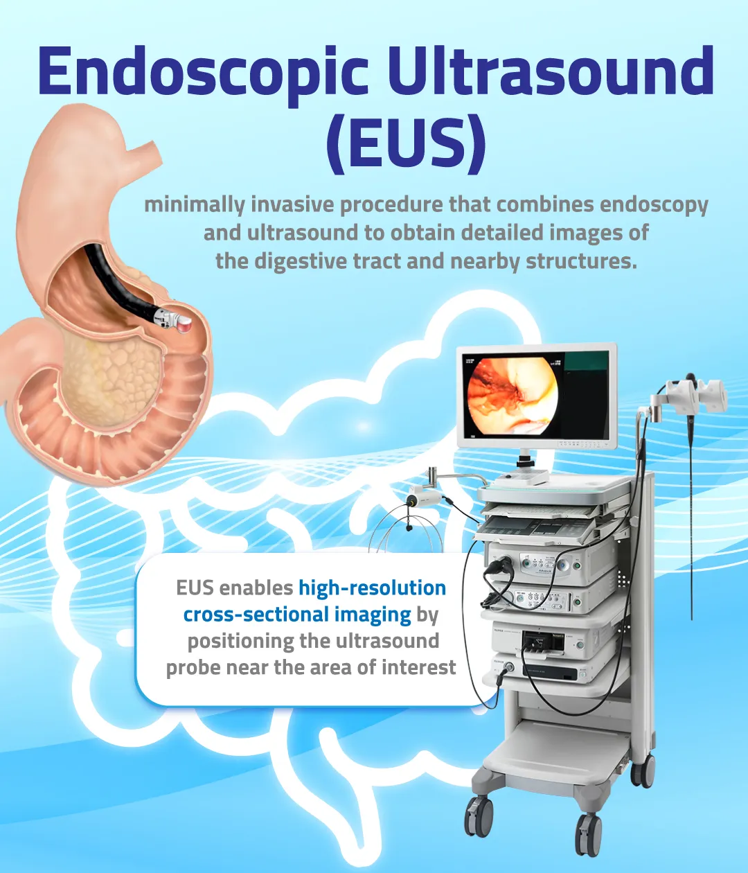 Endoscopic Ultrasound (EUS)